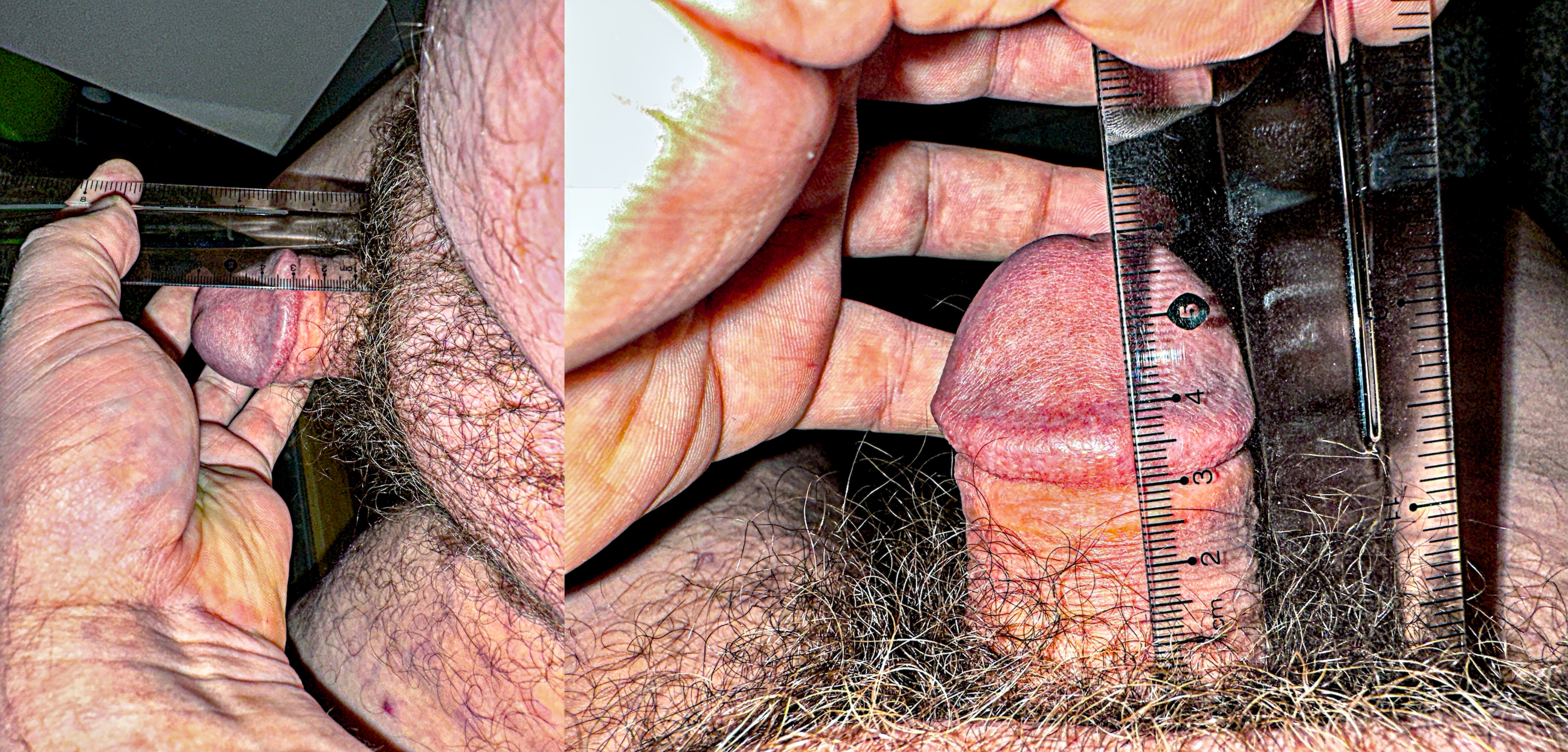 Micropenis measured with ruler, 6cm, 2.3 inches